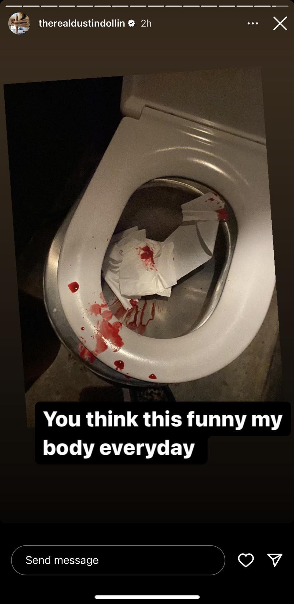 Dustin Dollin Shows Vomit Blood