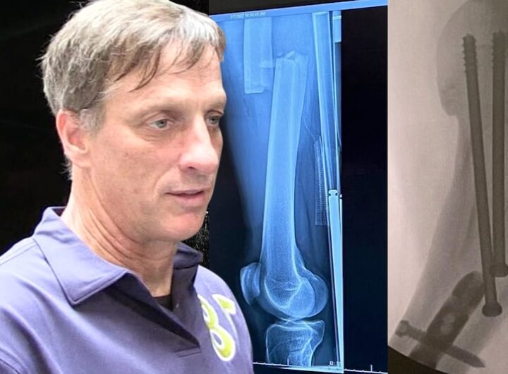 Tony Hawk broke his leg