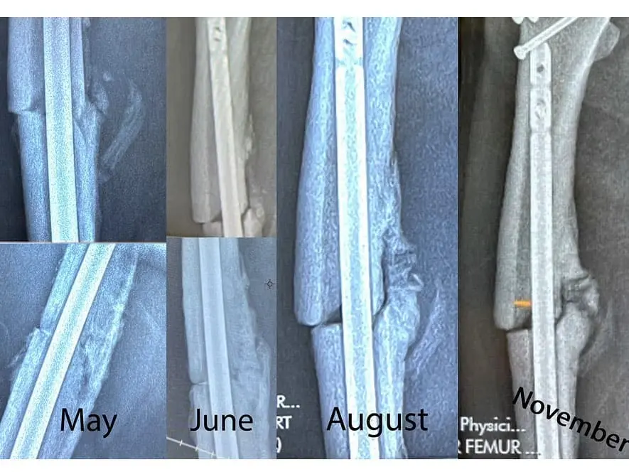 Tony Hawk's Broken Femur Got Worse